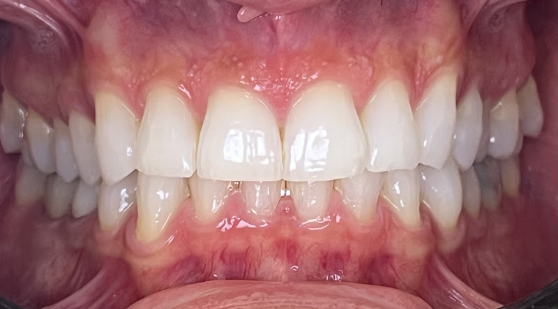 Clínica Adelantado | Estética dental Valencia