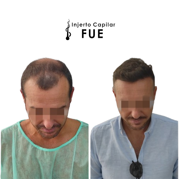 Clínica Injerto Capilar FUE