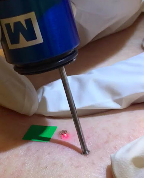 Depilfacil – Técnicos en Depilación Láser