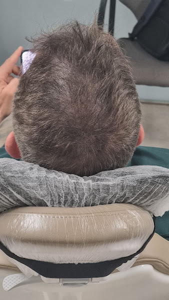 Micropigmentación Capilar Galicia